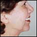Facial Minisculpture