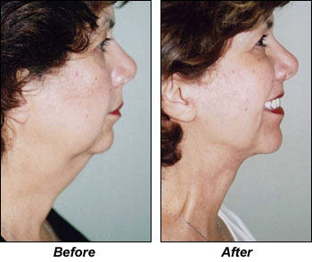 Facial Minisculpture